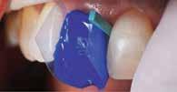 Οι όψεις ενσωματώνονται στο οδοντικό τόξο φυσικά και αόρατα Η οδοντική μορφολογία συνδυάστηκε ορθοδοντικά με αυτή των παρακείμενων δοντιών, ενώ το ελαφρώς ασύμμετρο