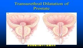 Transurethral balloon dilation Μικρή