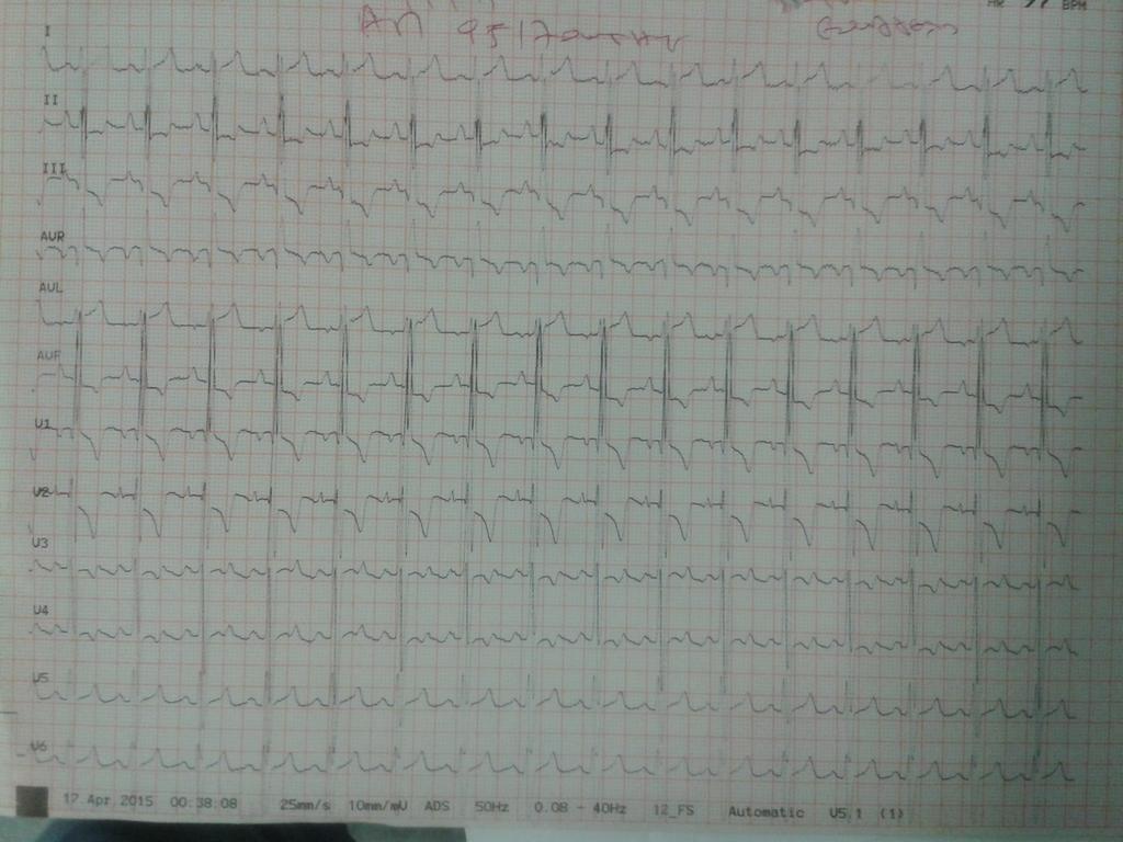 EKG=