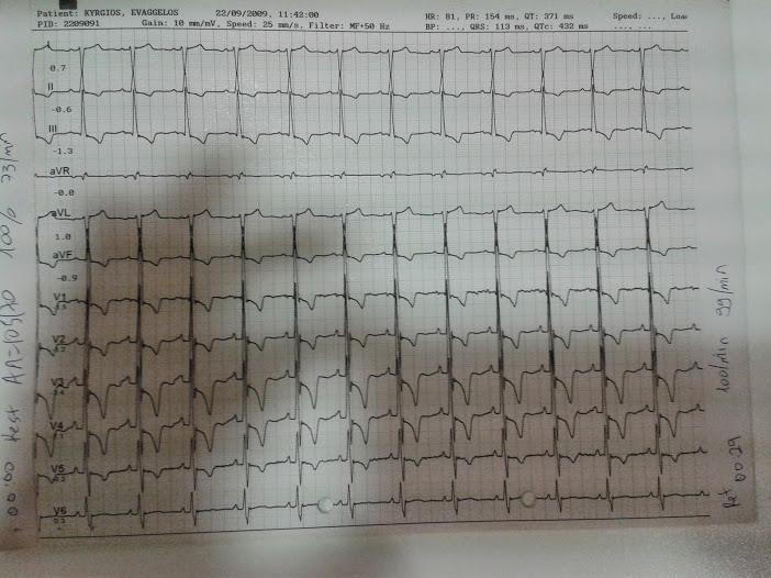 EKG=