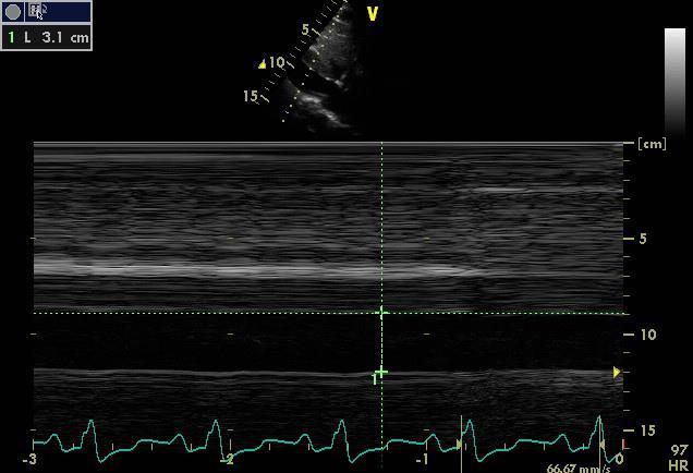 PA=36mm, S=8cm/sec, Περικαρδιακό