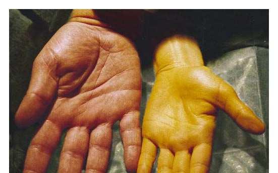 Hypercarotenemia(hand on the right)