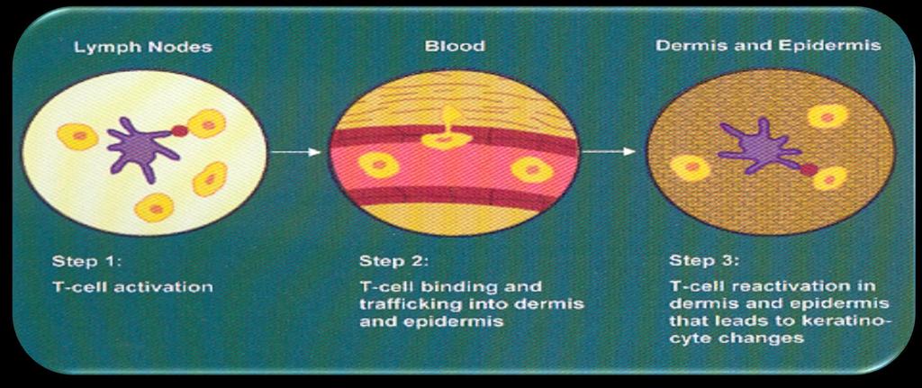 Παθοφυσιολογία της Ψωρίασης Στάδιο 1: Ενεργοποίηση των Τ-λεμφοκυττάρων από τα αντιγονοπαρουσιαστικά κύτταρα στους λεμφαδένες Στάδιο 2: Διακίνηση των Τ-λεμφοκυττάρων μέσω των αγγείων στο χόριο και