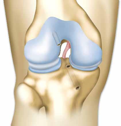 Η επέμβαση που σας προτείνουν Η επέμβαση που σας προτείνουν Εισαγωγή Ο χειρουργός σας προτείνει την αντικατάσταση του πρόσθιου χιαστού συνδέσμου του γόνατος.
