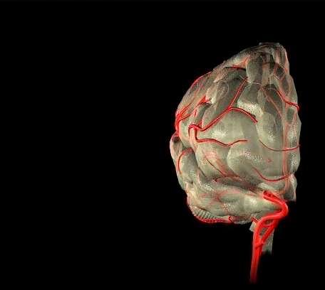 Εγκεφαλικό επεισόδιο Το αγγειακό εγκεφαλικό επεισόδιο είναι ένα έμφραγμα του εγκεφαλικού