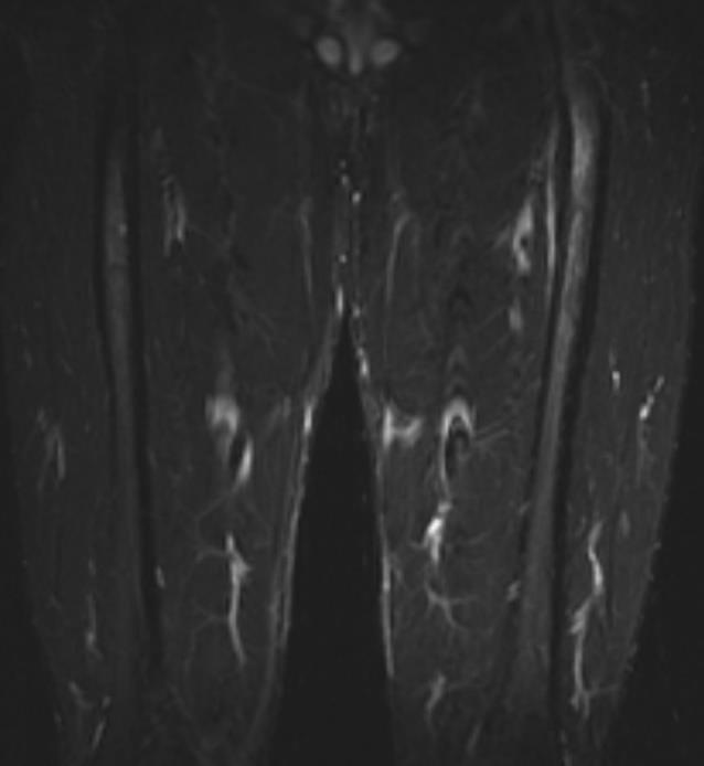 THIGH SPLINTS (ADDUCTOR