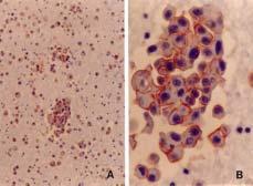 : E-cadherin. labelled streptoavidinbiotin(lasb). mouse E-cadherin(1:100, Zymed, South San Francisco, CA). 1 DAKO LSAB kit2. phosphate 3% hydrogen peroxide-methanol 5. phosphate 10 30.