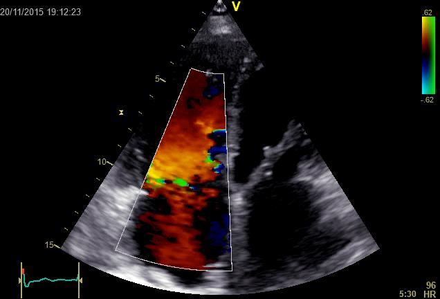 60 mmhg) RV, καλή συσταλτικότητα