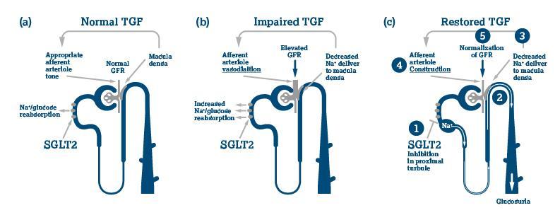 Πιθανός μηχανισμός νεφροπροστασίας με δαπαγλιφλοζίνη Σπειραματοσωληναριακή παλίνδρομη ρύθμιση (TGF) και αναστολή SGLT-2 1 Φυσιολογική κατάσταση Διαβήτης Υπερδιήθηση στα πρώιμα στάδια διαβητικής
