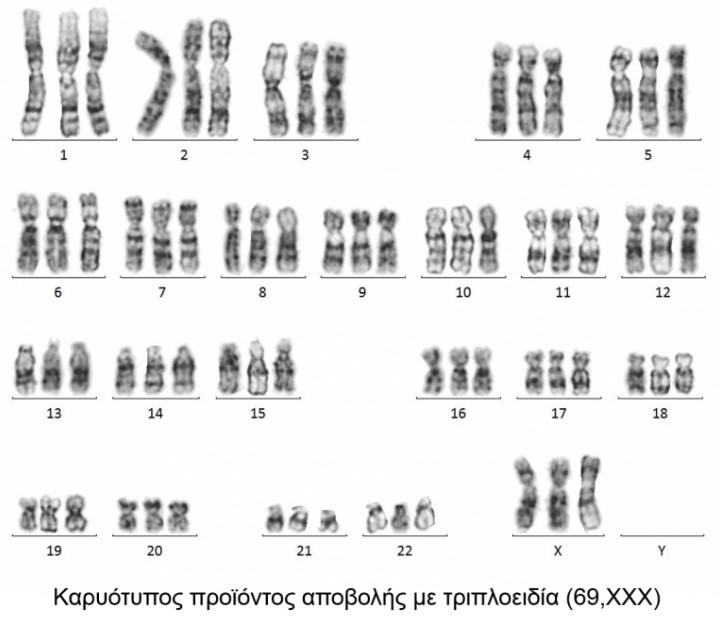 Τριπλοειδία Είναι η 3η πιο συχνή θανατηφόρος χρωμοσωματική διαταραχή που παρατηρείται στο προγεννητικό στάδιο. Τα χρωμοσώματα είναι τριπλασιασμένα έτσι ώστε ο πυρήνας των κυττάρων να έχει 69 αντί 46.