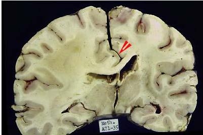 Υπερμεσολοβιακή/Υποδρεπανική κήλη τομή εγκεφάλου σε μεσότητα θαλάμων Διάχυτο εγκεφαλικό οίδημα με αποπλάτυνση