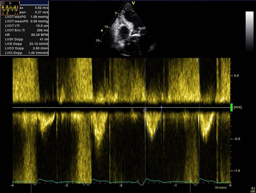 SVI=22ml/BSA