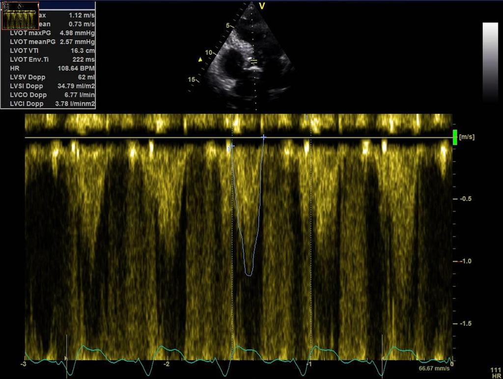 SVI=35ml/BSA