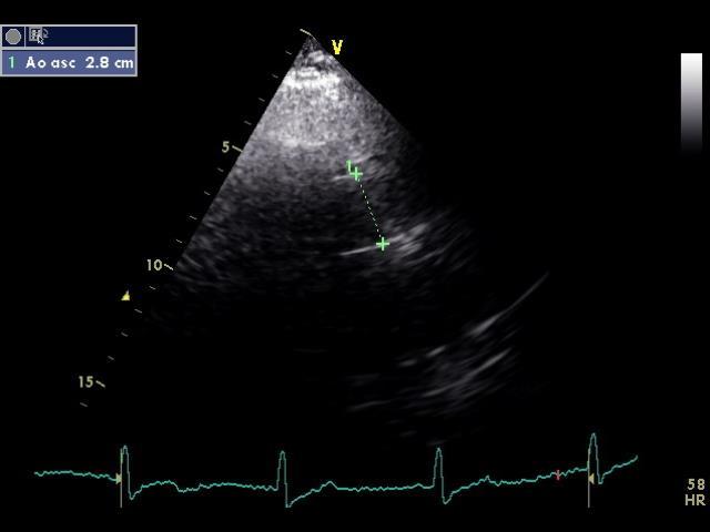 AO ASC = 2.