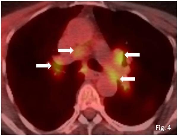 metastatic melanoma treated with ipilimumab.