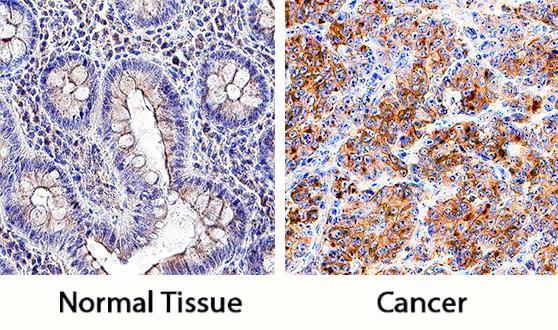 1 (pd-l1) from biopsy specimens COLON-