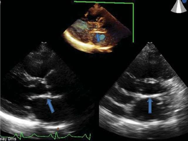 Aorto-mitral