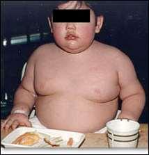 Επίπεδα LDL-C 140mg/dl σε υπέρβαρο/παχύσαρκο παιδί HeFH Αν και η υπερχοληστερολαιμία είναι συχνή σε υπέρβαρα/παχύσαρκα