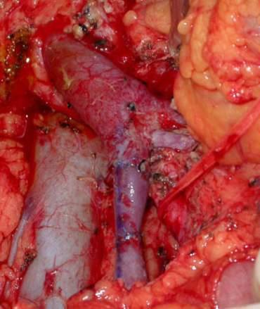 resected and an IJ interposition graft used to