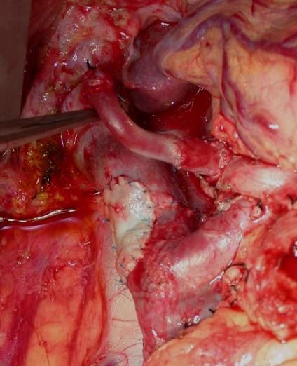 Final path: R0 Lymph nodes: 0/24 Rev saph vein graft