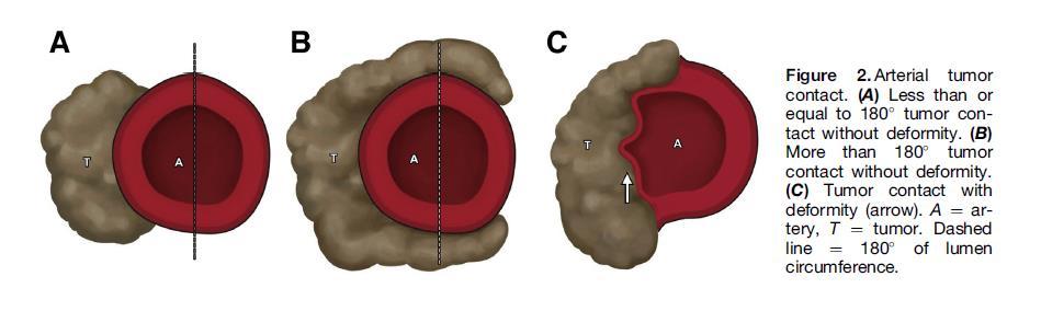 ΠΡΩΤΟΚΟΛΛΟ ΕΞΕΤΑΣΗΣ ΜΕ CT Tumor size and location Tumor and