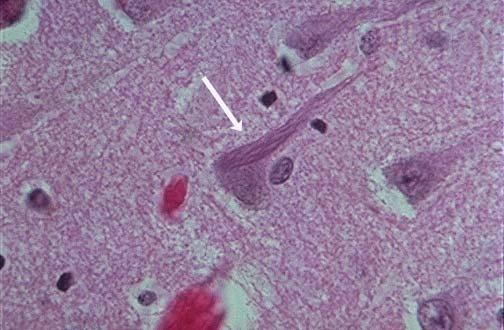 Νευροϊνιδιακοί κόμβοι δεμάτια από ζεύγη βασεοφίλων ελικοειδών ινιδίων