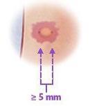 Mantoux (IΙ) HIV λοίμωξη Πρόσφατη επαφή με κρούσμα ενεργού ΤΒ Ινωτικές βλάβες