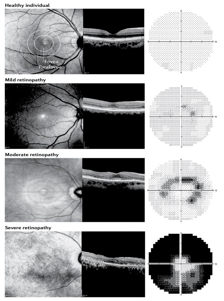 Πρόληψη οφθαλμοτοξικότητας Οφθαλμολογικός έλεγχος Spectral-domain optical coherence tomography (SD-OCT) Visual field examination (εξέταση οπτικών πεδίων) Αρχικός έλεγχος Περιοδικός επανέλεγχος