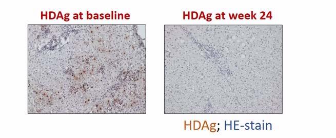 HDV RNA ή <2log decline Μείωση του