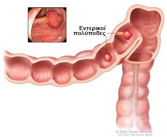 - Ιστορικό πολυπόδων στο παχύ έντερο: Μάζες στο παχύ έντερο που ονομάζονται πολύποδες* ή αδενώματα* δενείναι κακοήθεις. Ωστόσο αυτές οι μάζες μπορούν με την πάροδο του χρόνου να εξαλλαγούν σε καρκίνο.