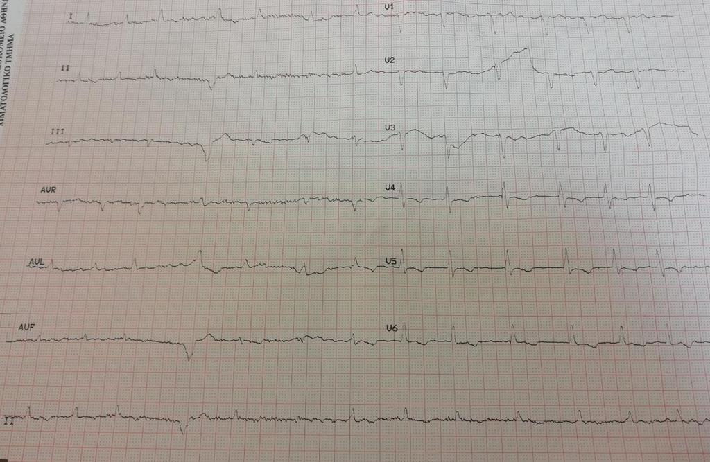 ΗΚΓ εισαγωγής: ΑF, 80 bpm, διαταραχές