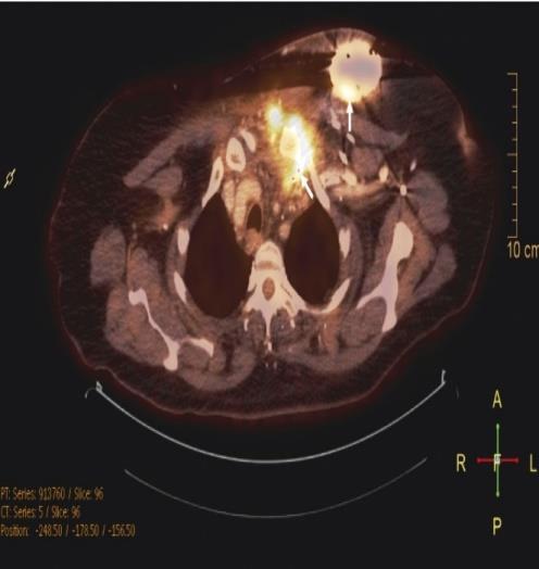 ΠΥΡΗΝΙΚΗ ΑΠΕΙΚΟΝΙΣΗ SPECT/CT: αυτόλογα ραδιοσεσημασμέ