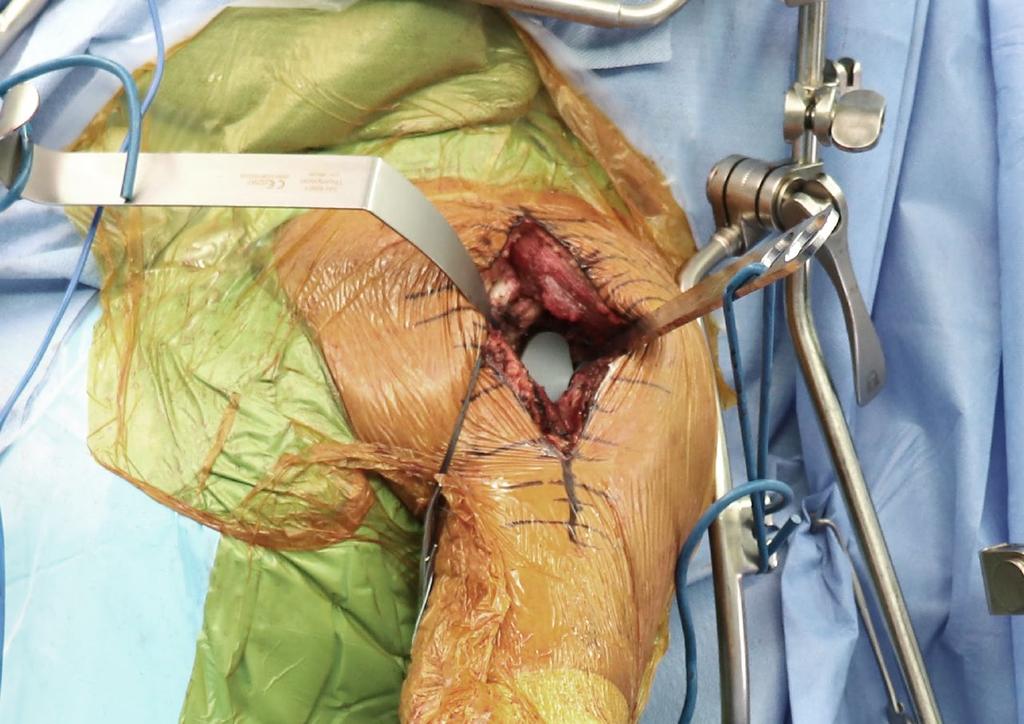 Thompson Techniques: SHOULDER EXPOSURE USING HIP SYSTEM FRAME Throughout my career I have always clipped my retractors to the drapes, only to re-adjust several times