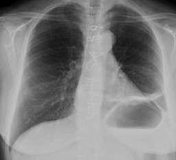 ΑΤΕΛΕΚΤΑΣΙΑ Η περισσότεροι ασθενείς εμφανίζουν μόνον plate-like atelectasis στις βάσεις του πνεύμονος.