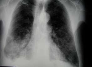 ΠΝΕΥΜΟΝΙΑ Η συχνότητα της μετεγχειρητικής πνευμονίας κυμαίνεται μεταξύ 2% και 20%.