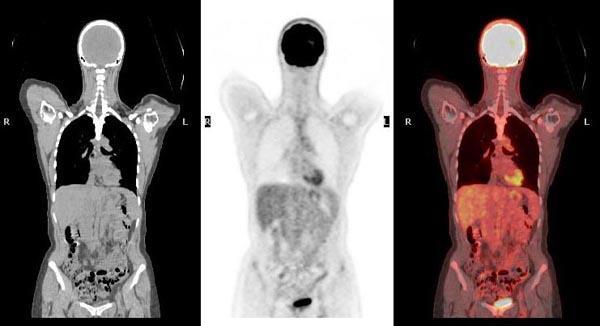 PET scan: