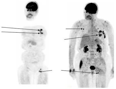 PET scan: μη