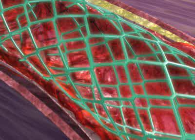 Επεμβατική αντιμετώπιση Επικαλυμμένα stent: τόσο η χρήση τους όσο και οι ενδείξεις τους