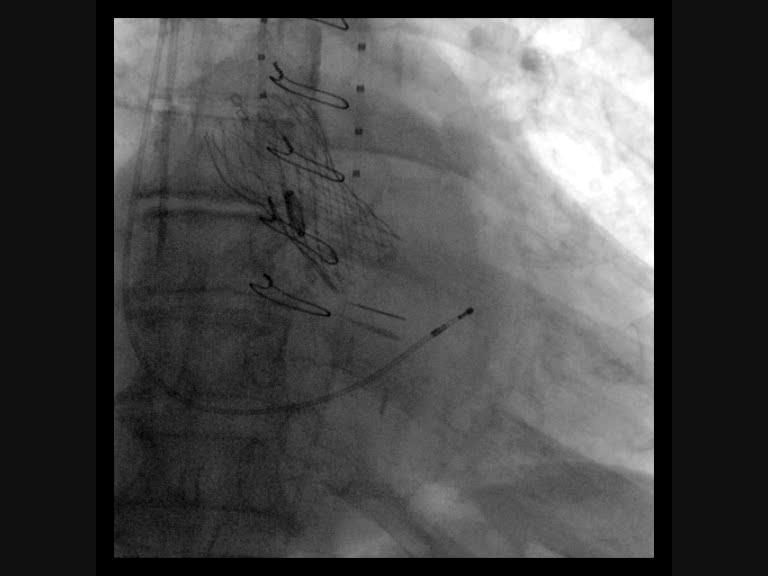 TAVI: Core Valve Toutouzas K,.
