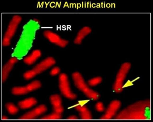 Γονιδιακή ενίσχυση: Το Ογκογονίδιο N-myc Ενίσχυση του πρωτο-ογκογονιδίου N-myc ανιχνεύεται σε περίπου 1/4 των πρωτοπαθών νευροβλαστωμάτων παιδιών.