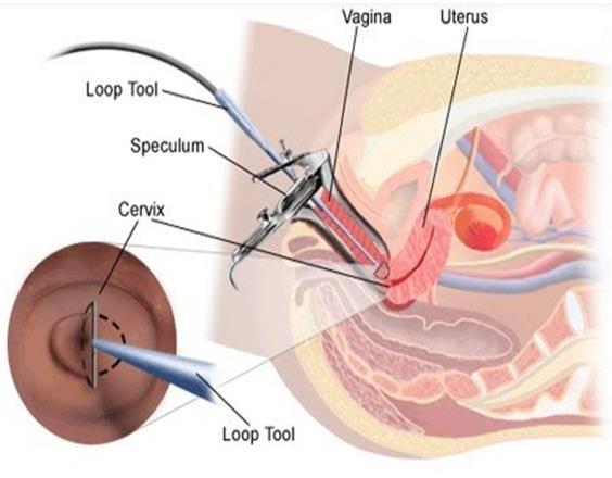 Εμβολιασμός ενηλίκων με τραχηλική βλάβη SPERANZA study: 80% clinical effectiveness in disease relapse after conization (re-infection) Ghelardi et al. _ Gyn Onc.