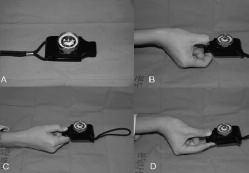 Η διαδικασία επαναλαμβάνεται 2 έως 3 φορές με το κάθε χέρι, με ενδιάμεσα διαλλείματα δύο-τριών λεπτών. Το μη τραυματισμένο χέρι χρησιμοποιείται για σύγκριση.