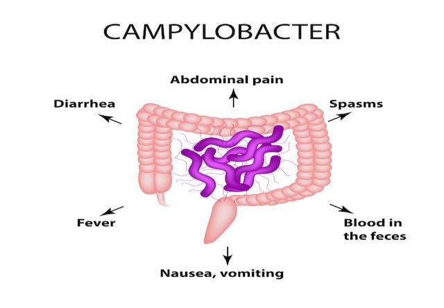 ΚΑΜΠΥΛΟΒΑΚΤΗΡΙΩΣΗ Καμπυλοβακτηρίωση ονομάζεται η μόλυνση από βακτήρια του γένους Campylobacter. Τουλάχιστον δώδεκα είδη εμπλέκονται σε ασθένειες του ανθρώπου, με το C. jejuni και το C.