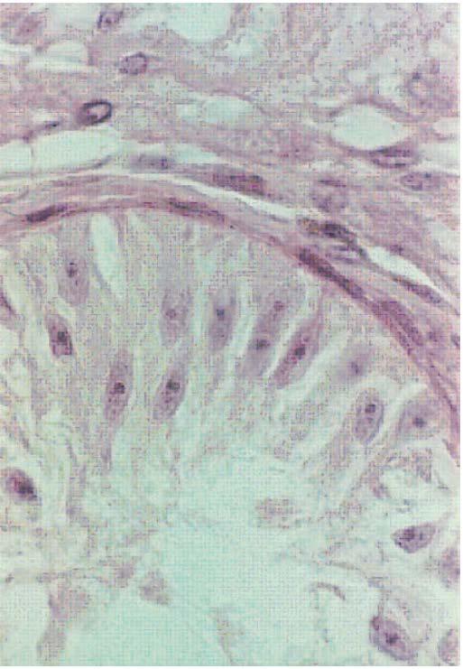 σωληναρίων (tubular sclerosis) Sertoli cell-only