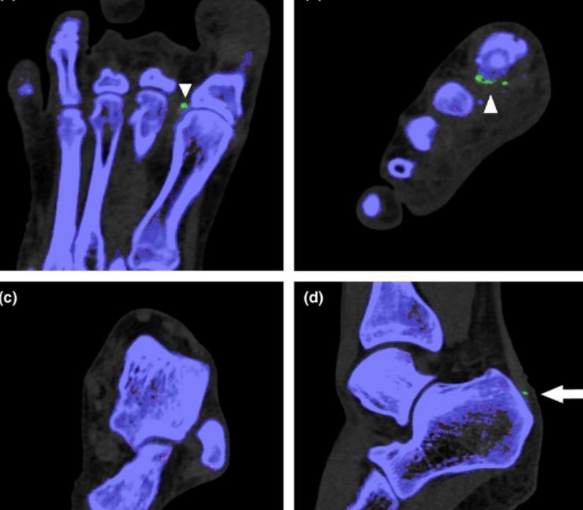 Dual energy CT ευαισθησία και