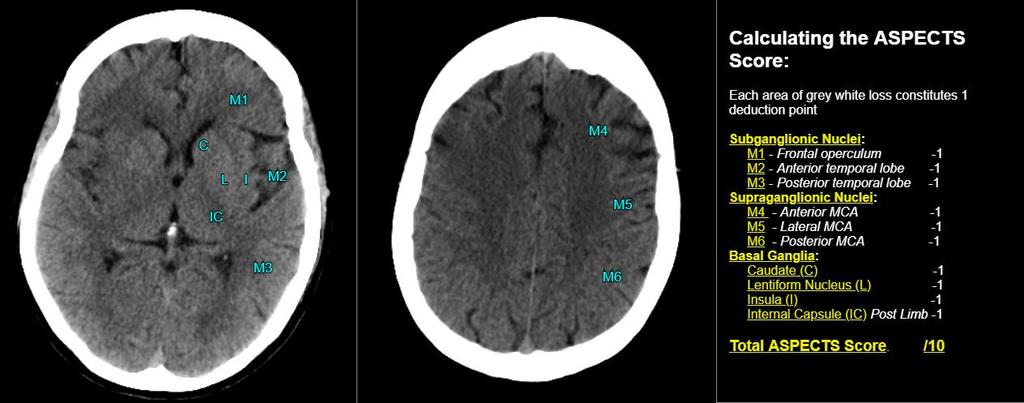 ASPECTS 0-10 Το παρέγχυμα της μέσης εγκεφαλικής διαιρείται σε 10 τμήματα στην απλή CT εγκεφάλου 10= δεν υπάρχουν πρώιμα σημεία ισχαιμίας 0= ολόκληρη η μέση εγκεφαλική αρτηρία έχει χαθεί