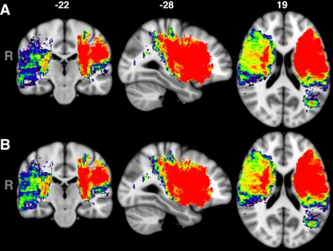 της βλάβης Wu O, et al. Stroke. 2015;46:2438 2444.