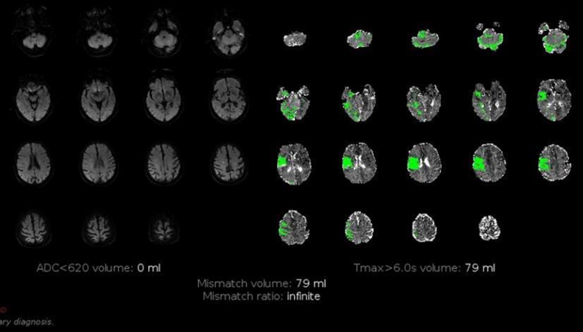 MR PERFUSION RAPID Οι ισχαιμικές βλάβες θεωρούνται μη αναστρέψιμες αν