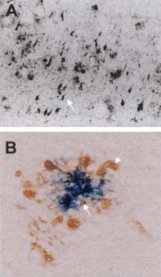 Εικόνα 12. Α. Νευροϊνιδιακά τολύπια. Β. Γεροντικές πλάκες. Αναδημοσίευση από Hardy J.