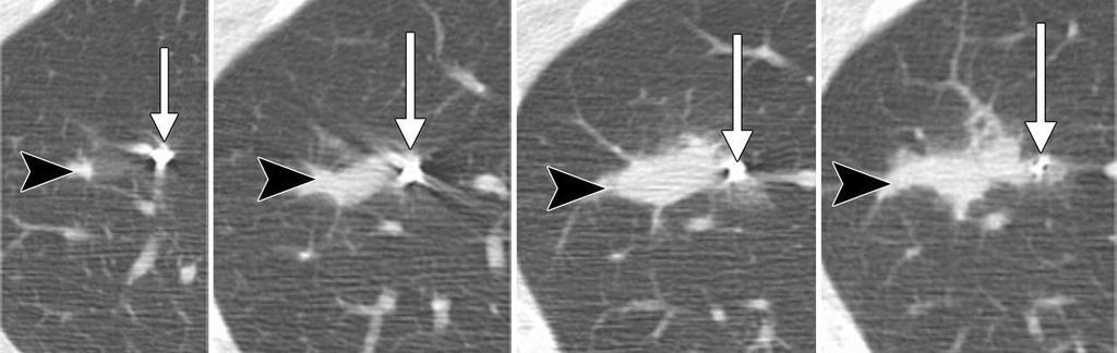 CT fluoroscopy